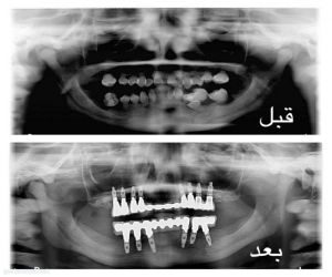 مدينة سعود الطبية تنهي معاناة شقيقتين أسنانهما تتحرك بشكل كامل بالرياض