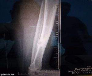 نجاح إزالة خراج عميق في عظام الساق الأيسر لمريضة بمستشفى أبو عريش العام