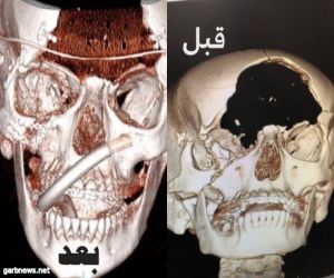 "سعود الطبية" تسجل إنجاز طبي في "ترميم جبهة" فتاة